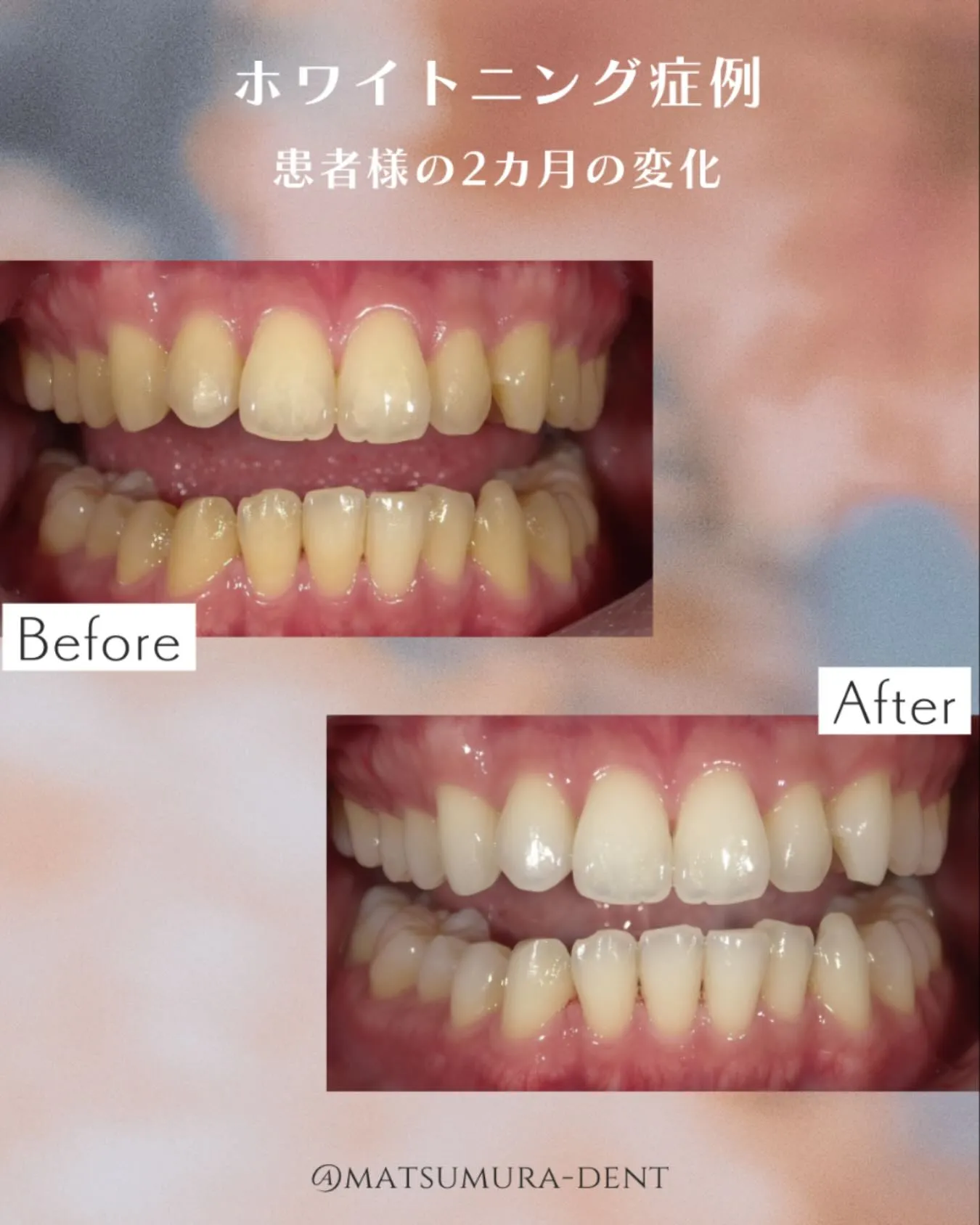 ホワイトニング症例🤍