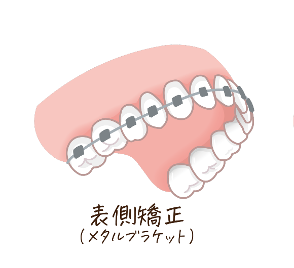 表側矯正