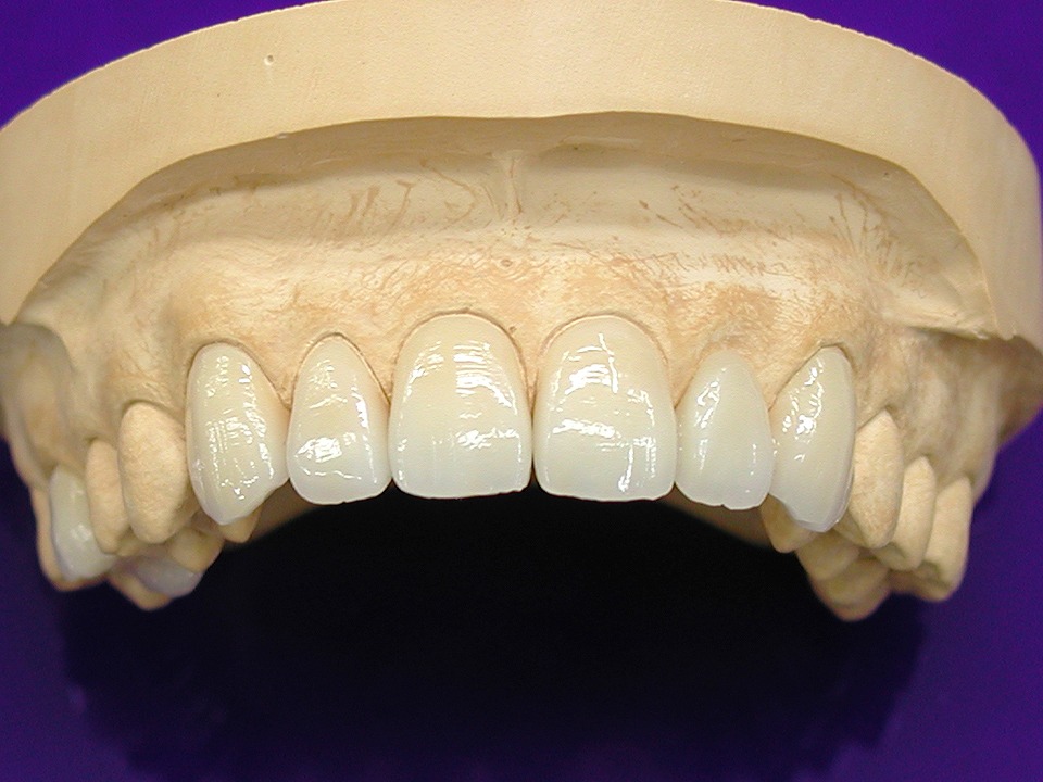 セラミックで修復した歯の寿命