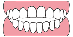 オープンバイト（開咬）