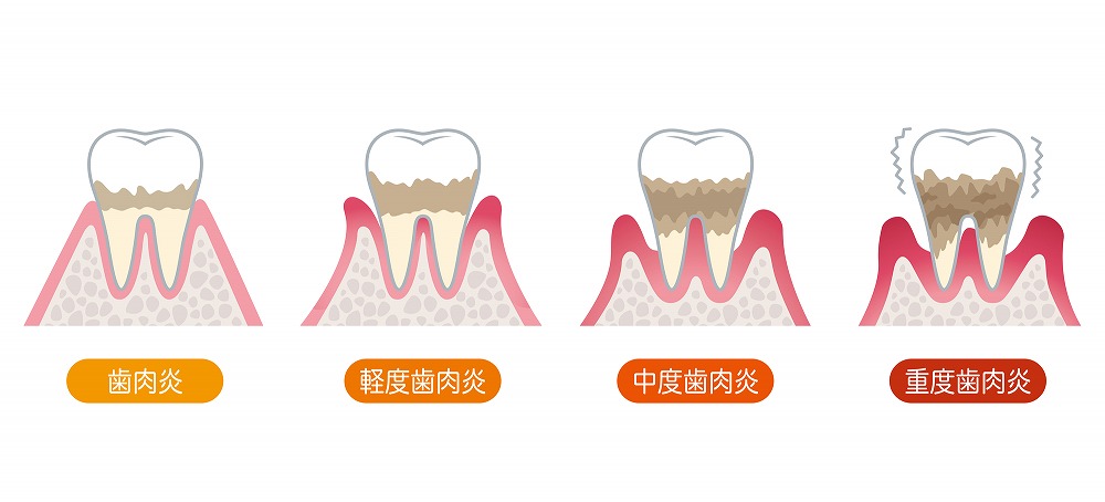 歯周病の進行は4段階